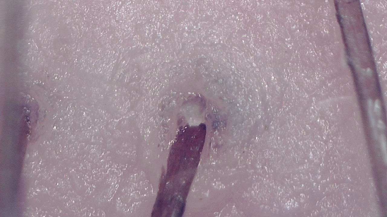 Trichoscopy for Hair and Scalp microscopy sample image 1