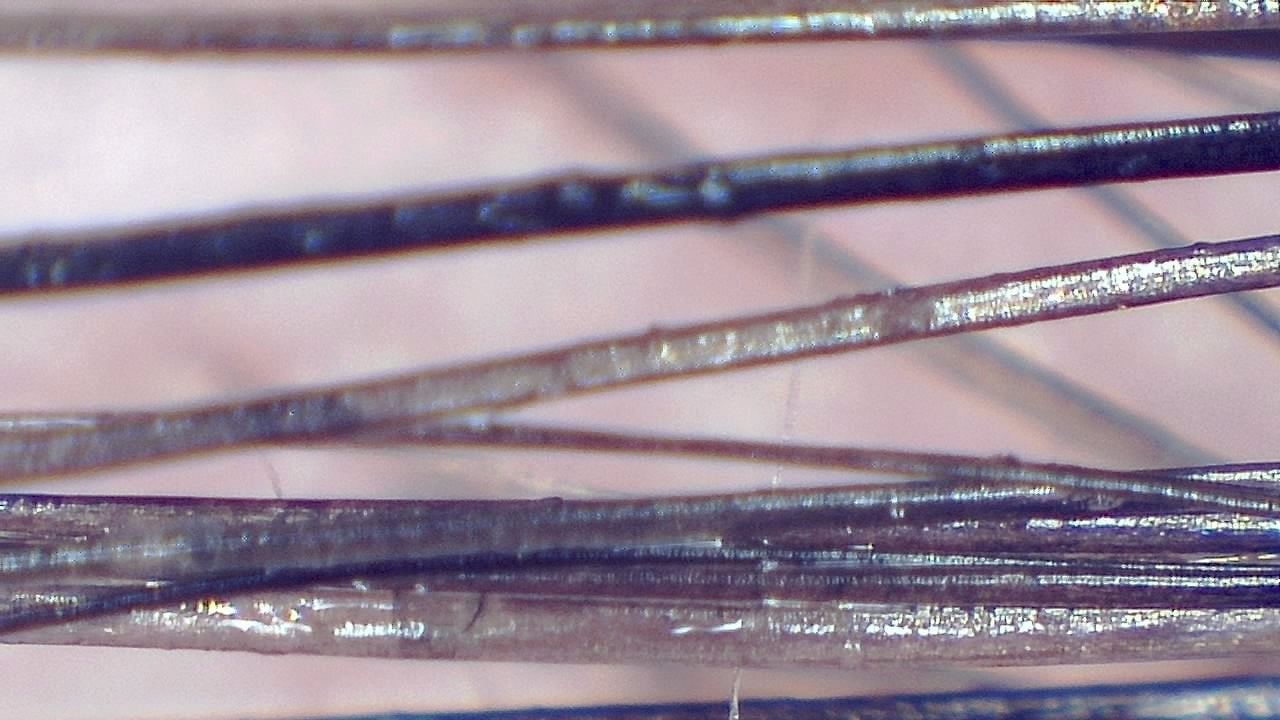 Trichoscopy for Hair and Scalp microscopy sample image 5